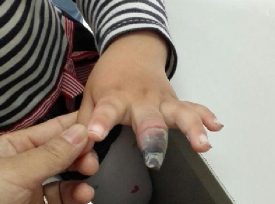 一岁多宝宝脸上破皮,两岁孩子脸破皮