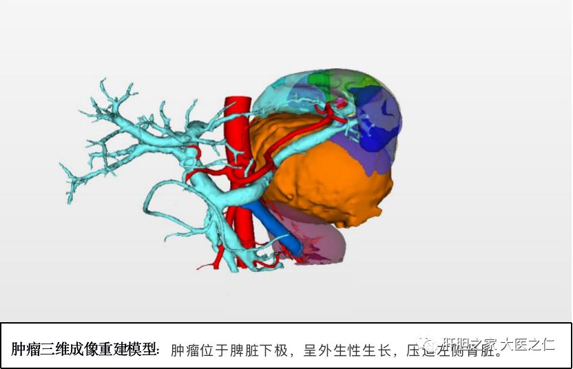 南昌大学二附院肝胆胰外科王恺教授团队为一例“脾脏巨大囊性占位”患者成功实施了腹腔镜下脾脏部分切除手术