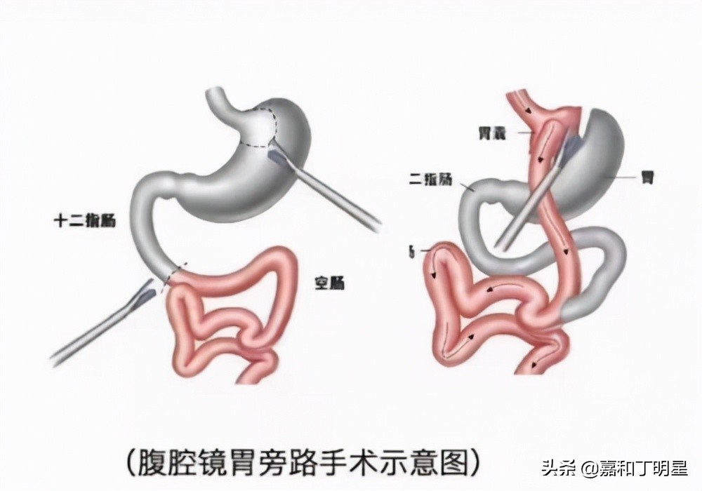 长春嘉和外科医院减重手术多少钱,吉林长春嘉和医院手术费用
