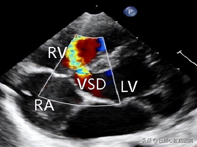 心脏室间隔缺损不治疗行吗,心脏有个洞要补吗
