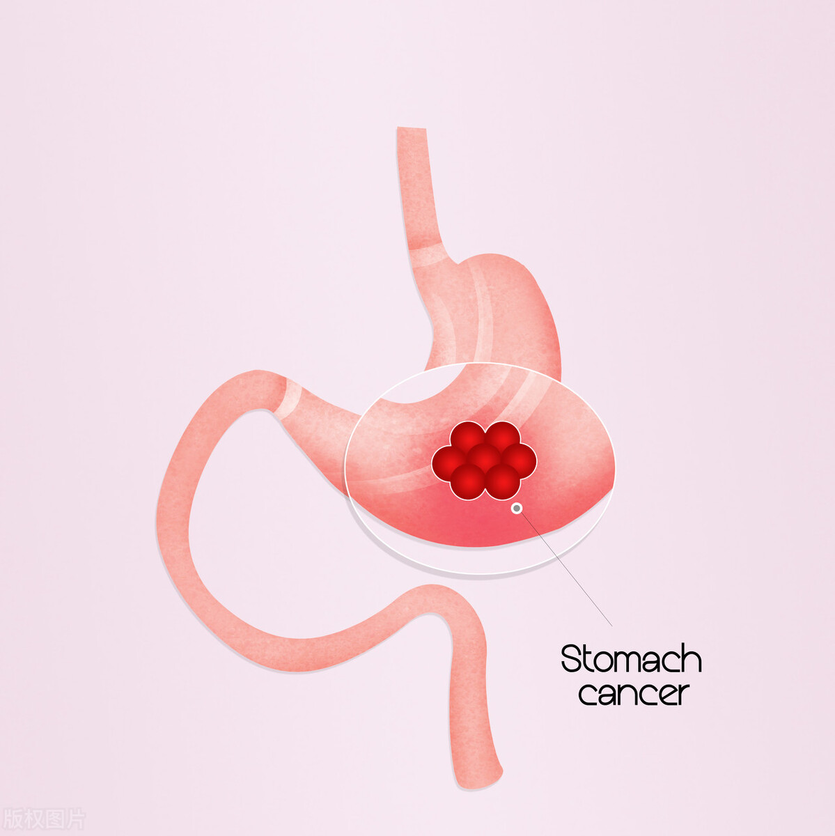 无痛胃镜全麻醒后需要注意的事项,做普通胃镜的正确方法减少痛苦