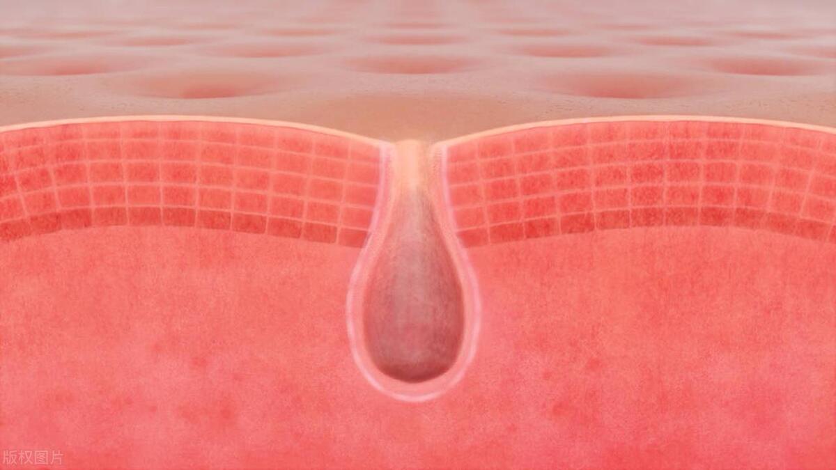 鼻子上的顽固黑头挤不出来怎么办,鼻子上的黑头一直不挤会怎么样