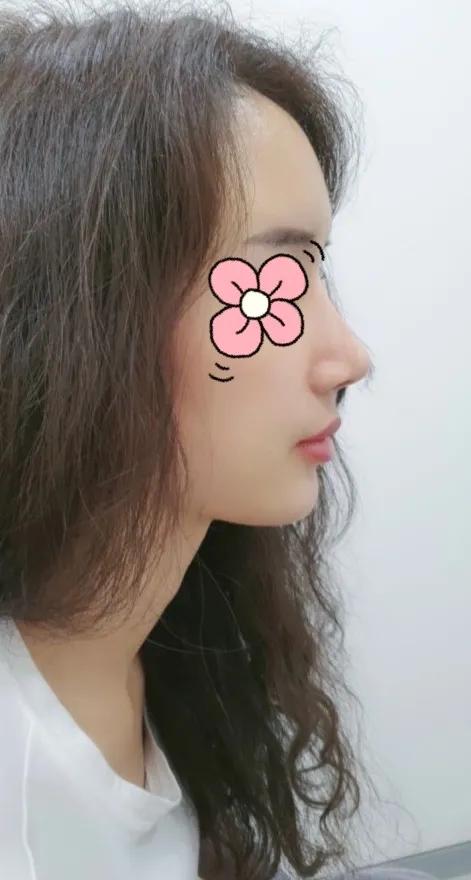 五官扁平脸怎么变高级感,扁平脸塌鼻子怎么改善