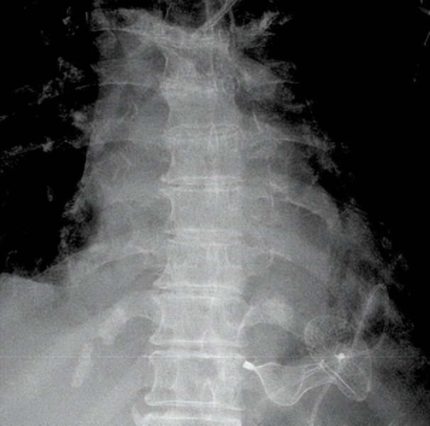 92岁老人心梗后室间隔穿孔四川大学华西医院心脏内科团队通过微创介入技术成功救治
