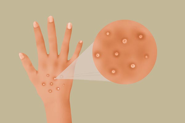 早上起来手肿胀难握拳怎么办,早起手指僵硬怎么回事