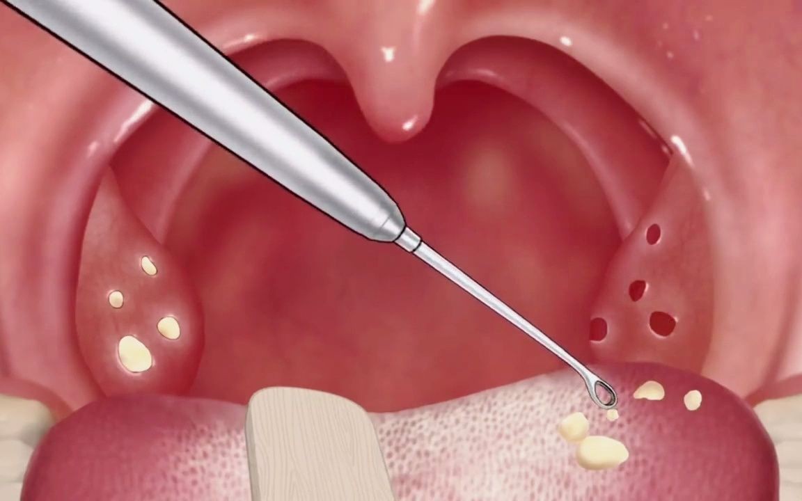 喉咙有异物感咳一下喉咙容易出血,喉咙有异物咳出水老是想咳