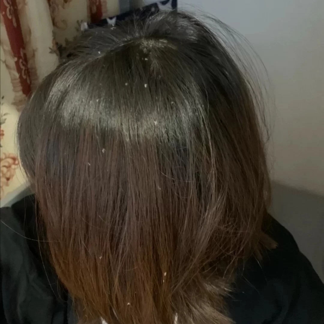 干性头皮屑去屑洗发水哪种最好,去头屑的洗发水哪一种最好