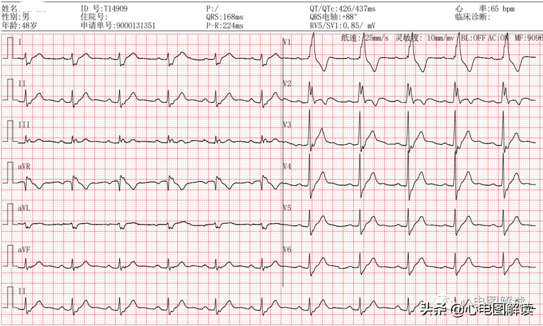 右束支阻滞qrs波形图解,右束支传导阻滞继发性st段改变