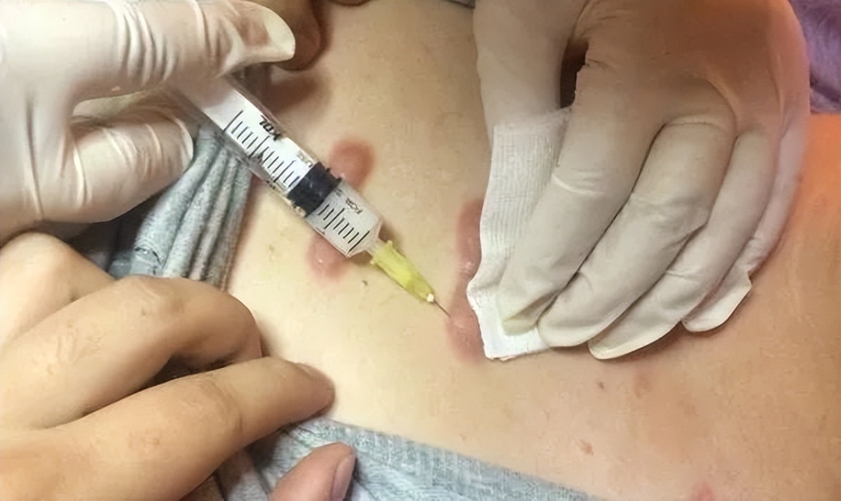 增生疤痕打软化针停药会反弹吗,疤痕增生一年打软化针有用吗