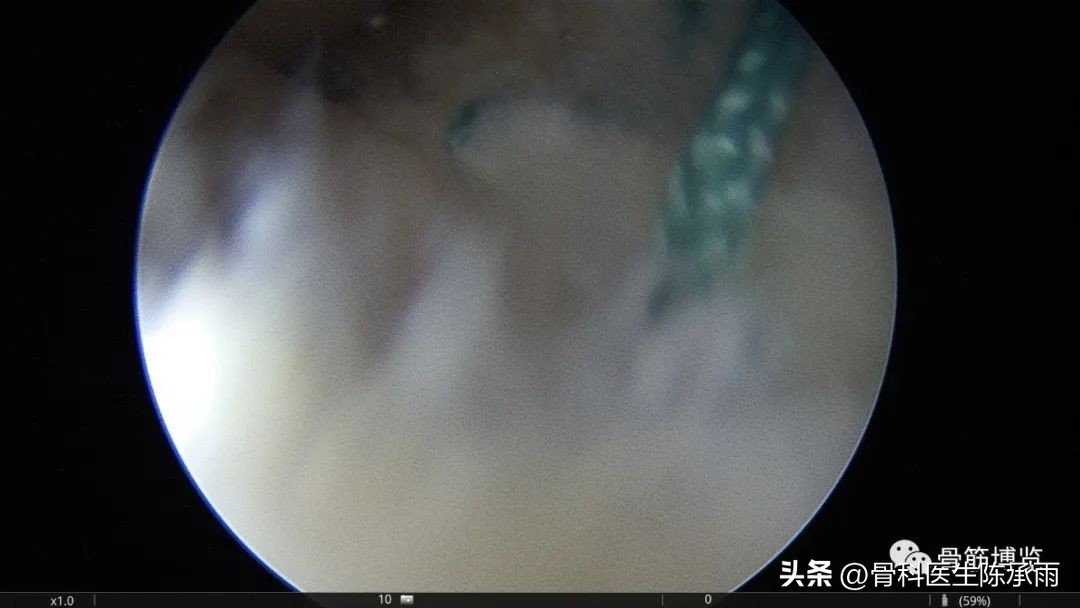 内侧半月板前角囊肿,关节镜下内侧半月板部分切除术