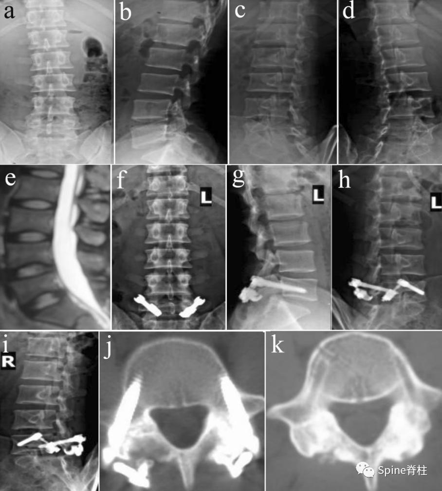 轻度峡部裂和重度峡部裂的区别,真性峡部裂和假性峡部裂