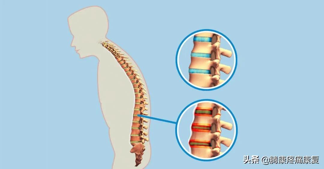 平背的成因,平背怎么造成的