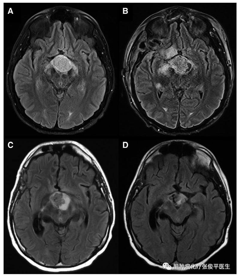 颅咽管瘤用靶向治疗效果如何,颅咽管瘤的手术策略和技术