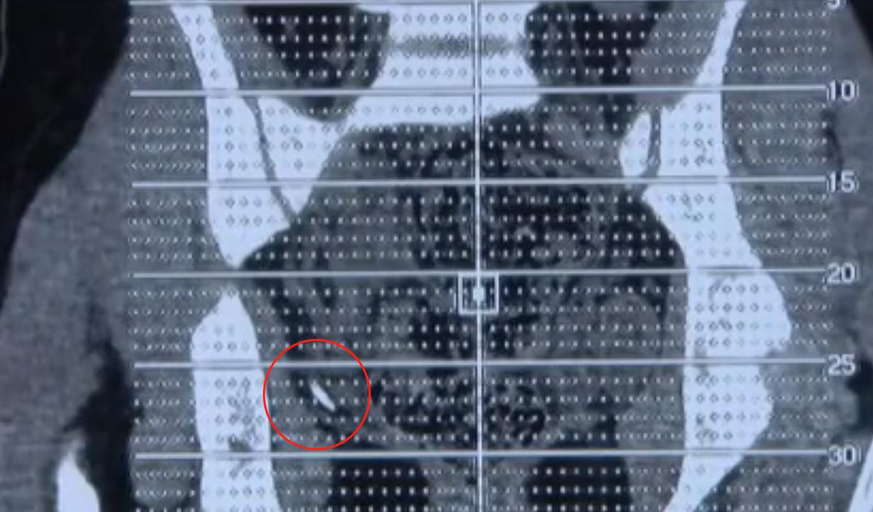 6岁女童腹痛检查出来母亲傻眼,重庆女子腹痛