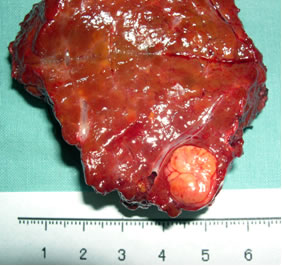 肝硬化患者甲胎蛋白在参考范围内升高，要警惕肝癌吗？