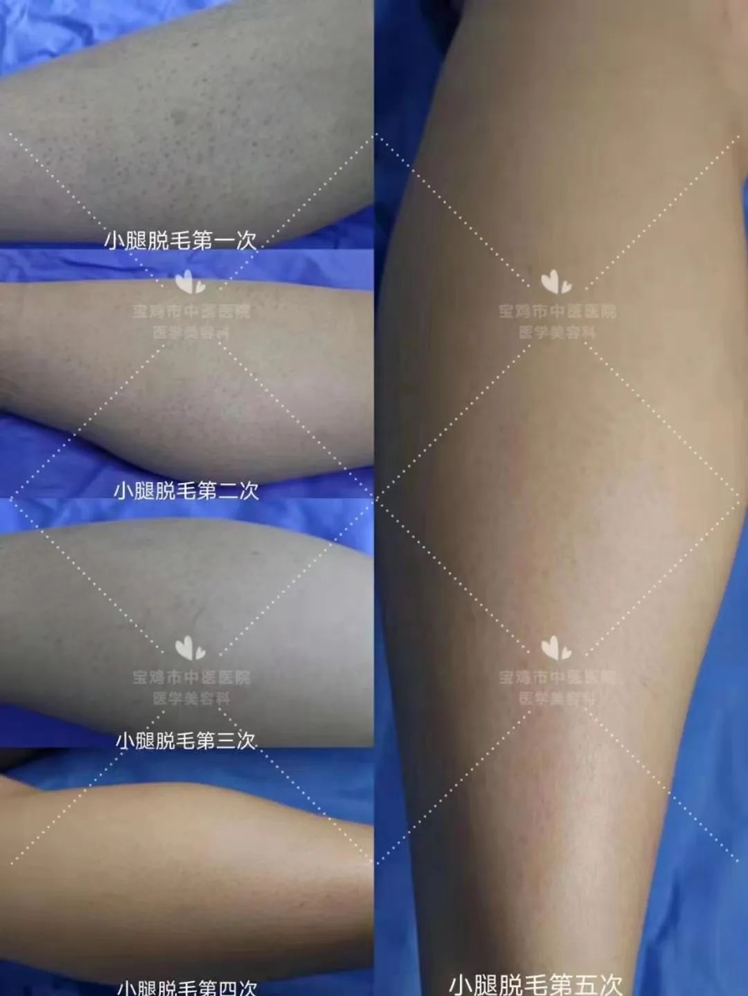 哪种脱毛方法永久脱毛不会再长毛,脱毛小妙招不伤皮