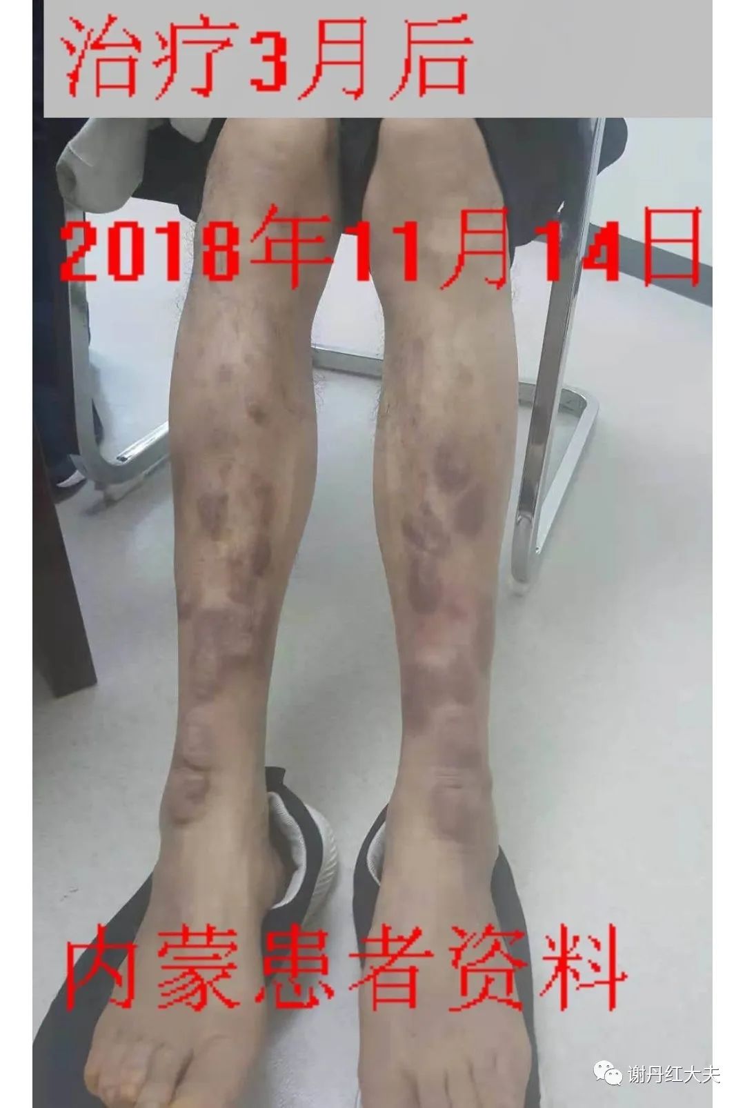 胫前黏液性水肿见于哪些病,胫前黏液性水肿为凹陷性水肿吗