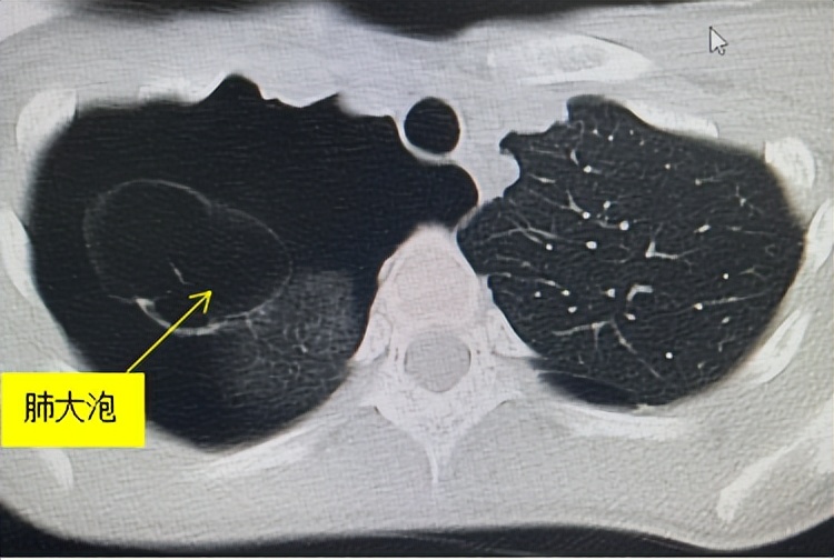 深呼吸右边肺漏气,感觉肺部漏气的感觉