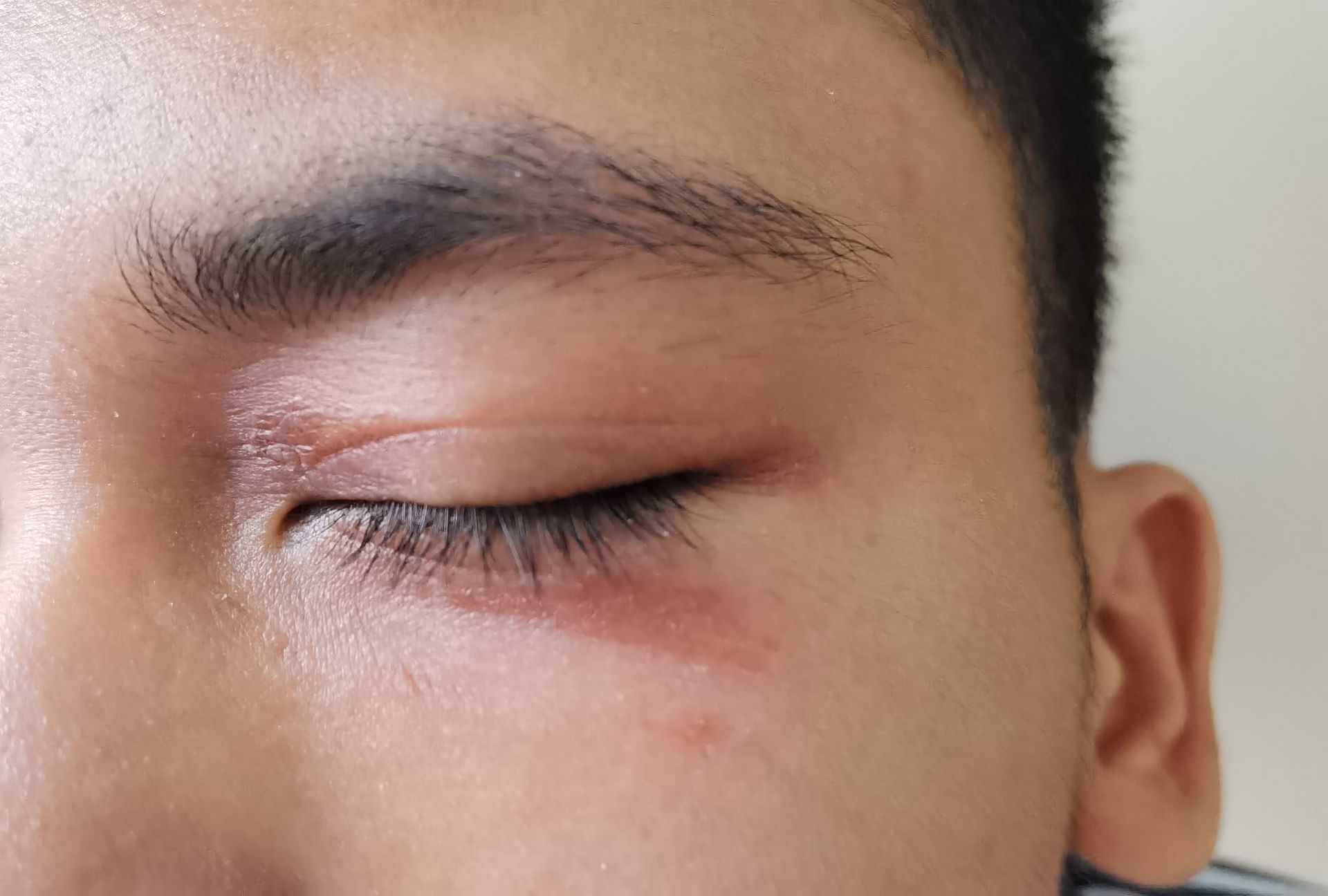 隐翅虫安全知识,当心隐翅虫