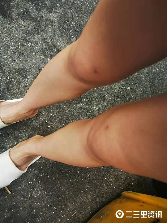 合肥福华整形失败案例,医美整形毁容