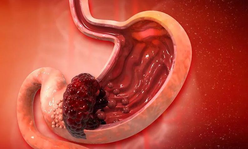 骞介棬铻烘棆鏉嗚弻鍙互闄嶄綆鑳冪檶椋庨櫓,鏍归櫎骞介棬铻烘潌鑿岃兘闄嶄綆鑳冪檶椋庨櫓