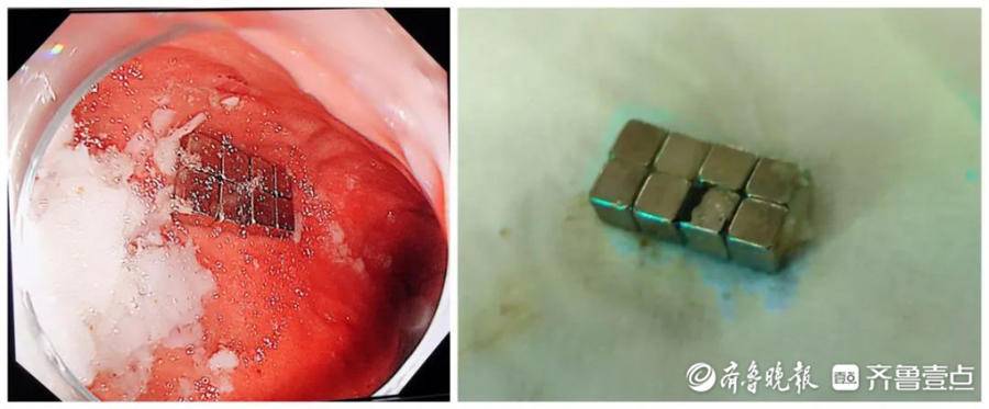 儿童误吞磁铁事故,儿童误吞8颗磁力球