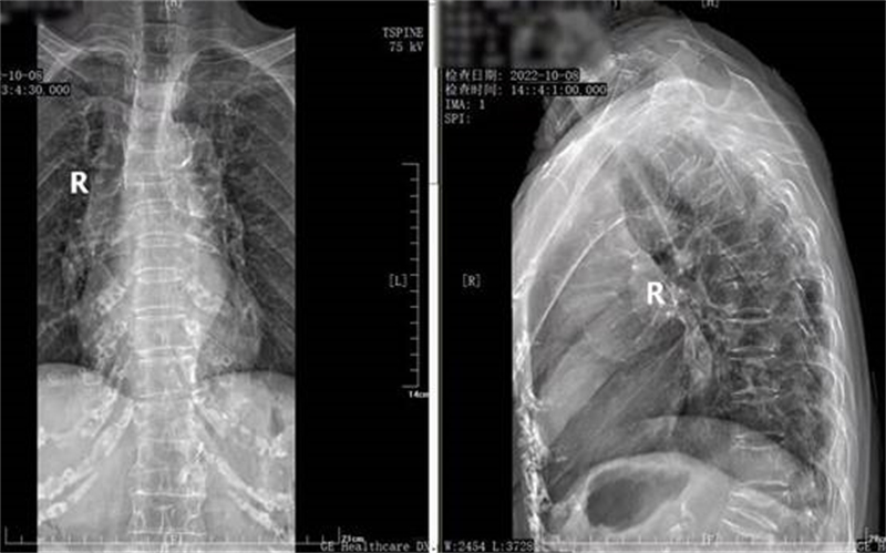 百岁老人骨折竟奇迹般恢复,老人骨折卧床100天还能走路吗