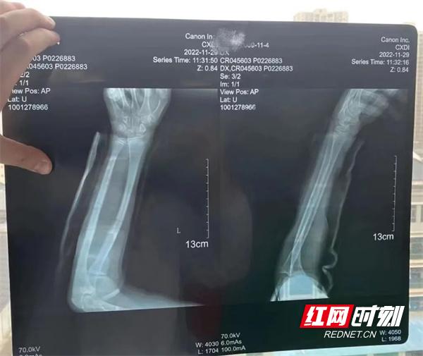 广州市正骨医院手骨骨折手法复位,桡骨骨折手法复位记录中医