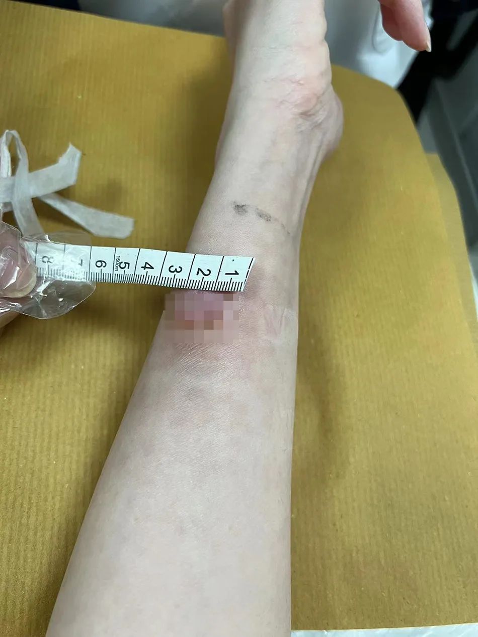 卷发棒卷爆炸了,卷发棒爆炸了会伤到人吗