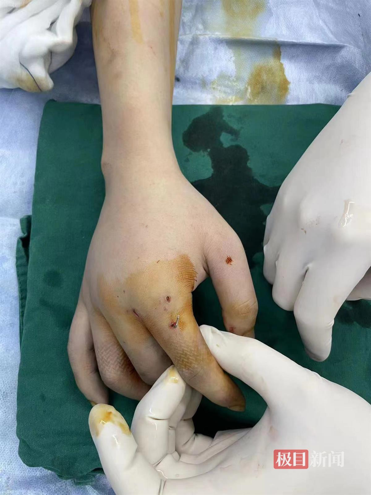 武汉小伙夜跑摔倒后手骨折，修复手术仅留下毫米创口