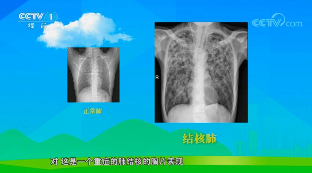 结核病该如何预防被传染,什么是结核病及预防方法