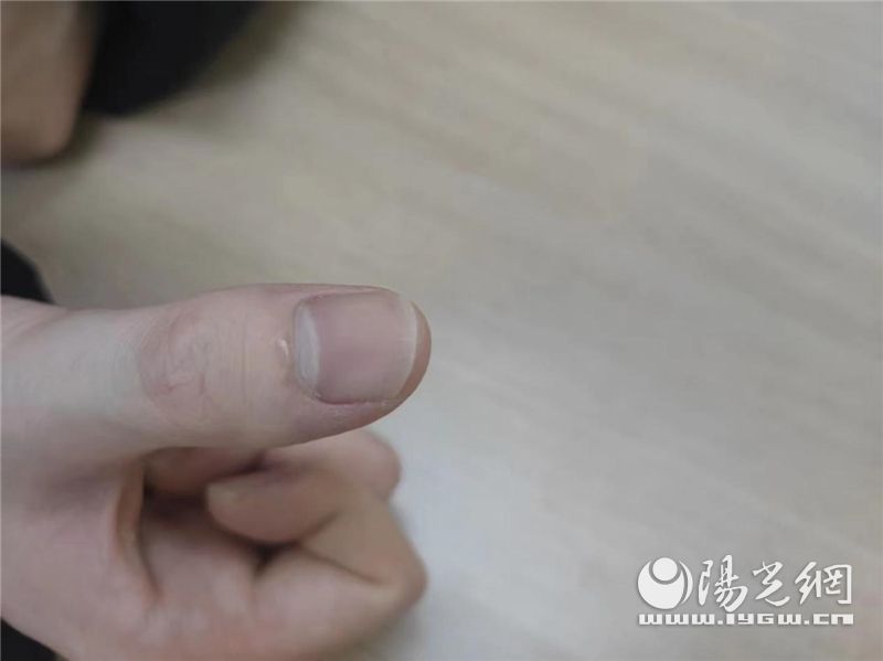 实验室强酸烧伤,化学实验室酸烧伤