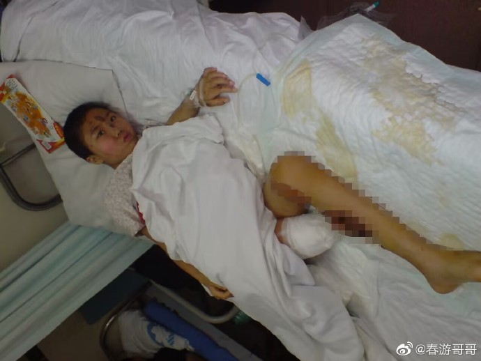 512汶川地震失去双腿的女孩,汶川地震中失去一条腿的女孩