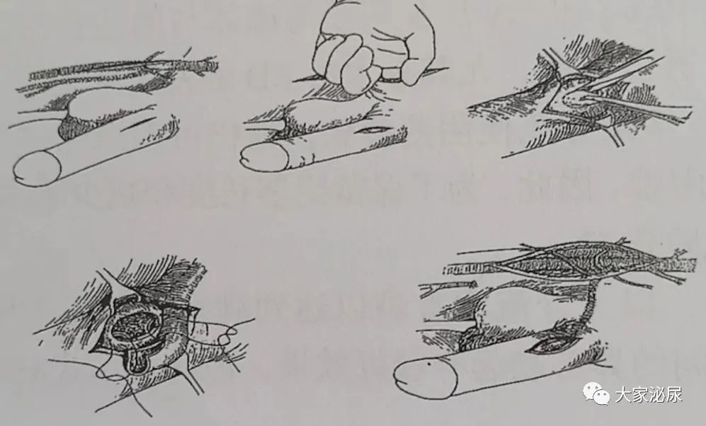 干货│缺血型阴茎异常勃起的治疗