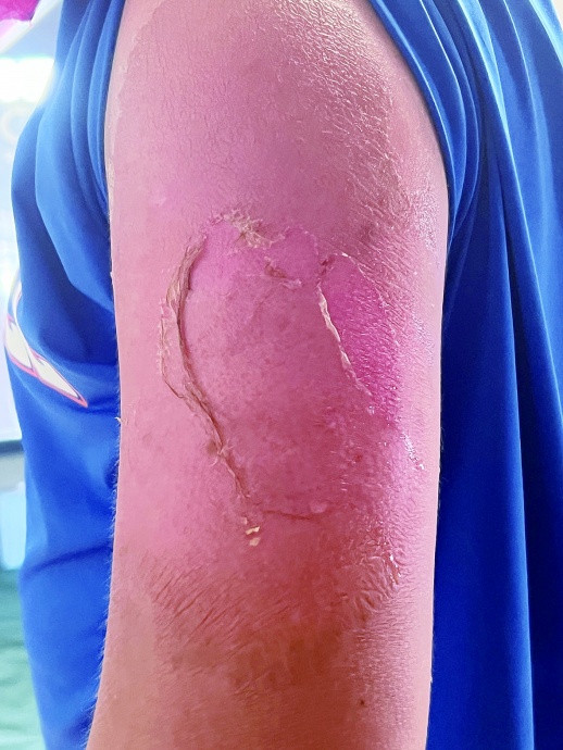 夏天的太阳太火辣孩子出游频频被晒伤建议:孩子晒伤这样紧急处理