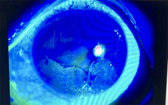 小男孩不慎将502滴入眼睛,被502粘到眼睛一秒解决方法