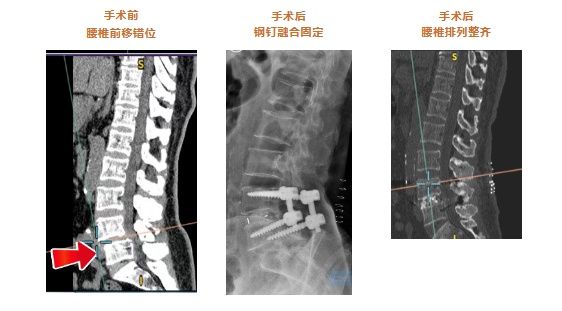 腰椎滑脱有救了,腰椎轻微滑脱有什么理疗的方法吗