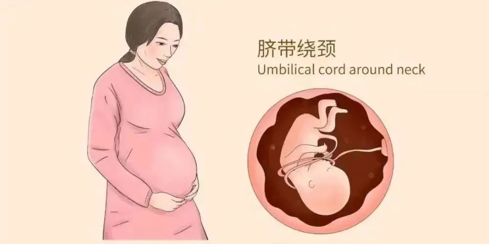 roa胎位脐带绕颈2周能顺产吗,胎儿脐带绕颈还可以进行胎教吗
