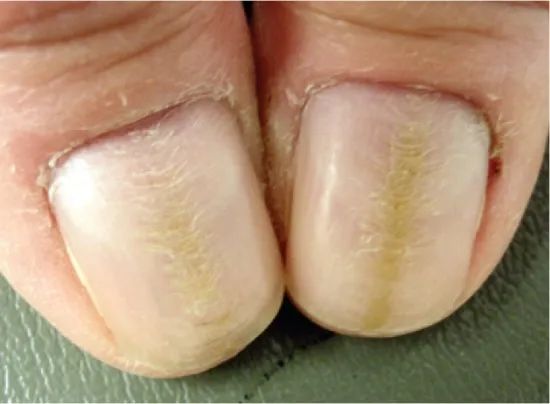 指甲有竖纹有月牙怎么回事,指甲月牙不是很白怎么回事