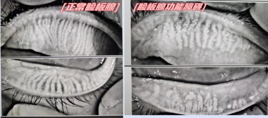 眼睛迎风流泪怕光怎么治用什么药,眼睛迎风流泪视力模糊是什么原因